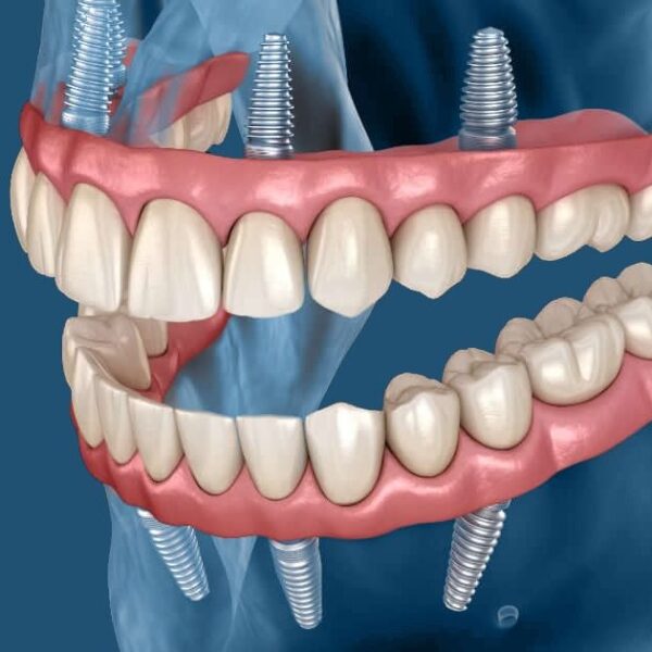 Implant Supported Fixed Dentures