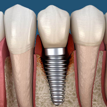 Get top quality and affordable Dental Implants at CIMA Oral surgery clinic in tijuana