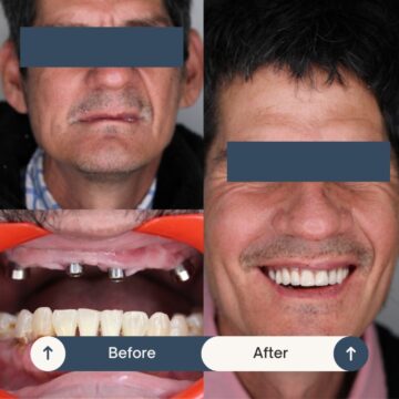 All-on-Four Smile Makeover Patient at Tijuana Dental Clinic CIMA Oral Surgery Before and After 1