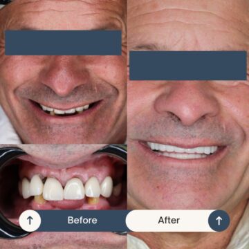 All-on-Four Smile Makeover Patient at Tijuana Dental Clinic CIMA Oral Surgery Before and After 2
