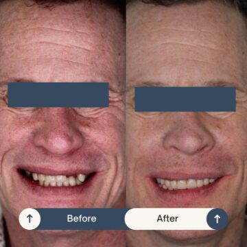 All-on-Four Smile Makeover Patient at Tijuana Dental Clinic CIMA Oral Surgery Before and After 3